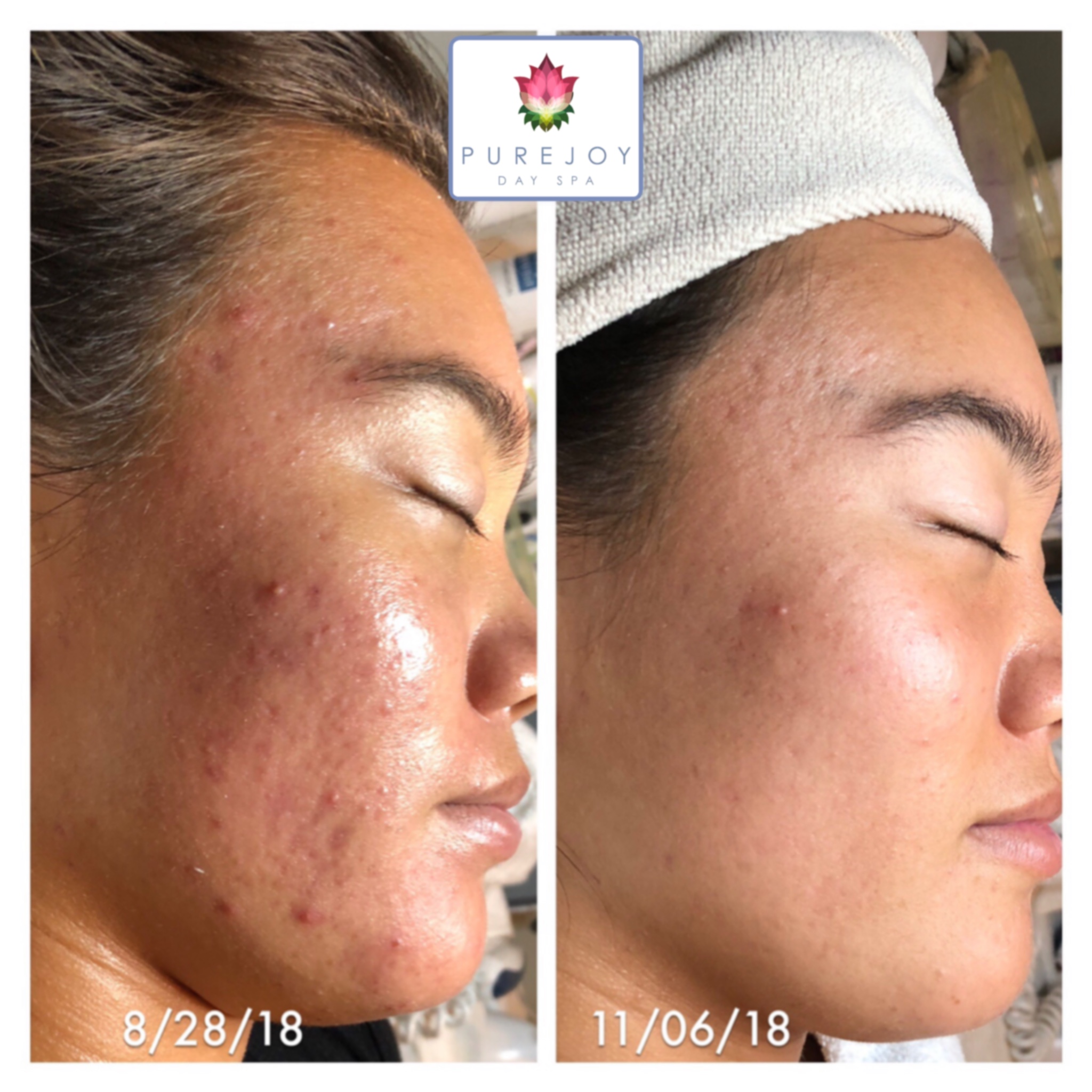 Acne Treatments